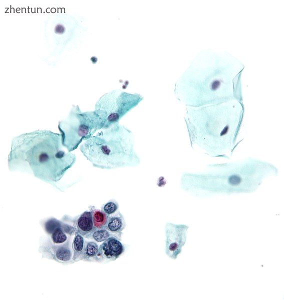 High-grade squamous intraepithelial lesion.jpg