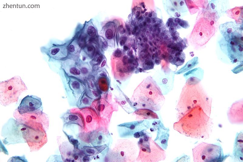 Micrograph of a Pap test showing a low-grade intraepithelial lesion (LSIL) and b.jpg