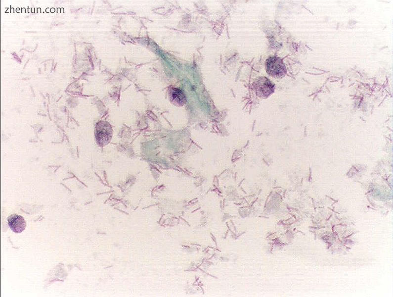 the cytoplasms of squamous epithelial cells melted out; many Dderlein bacilli ca.jpg