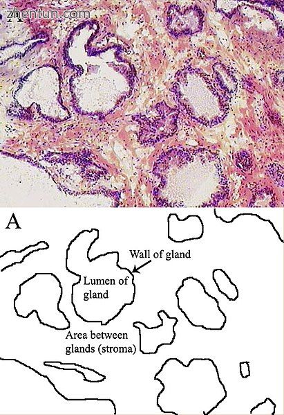 Microscopic glands of the prostate.jpg