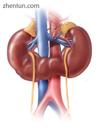 Horseshoe kidney.jpg
