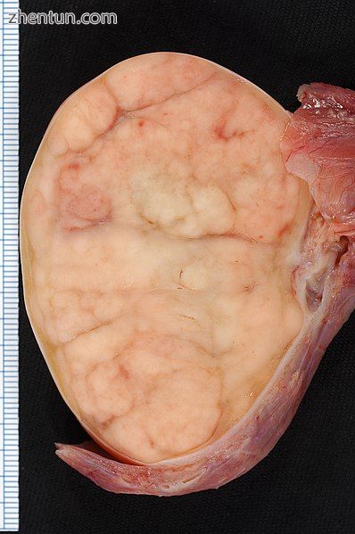 7.4 × 5.5-cm seminoma in a radical orchiectomy specimen..jpg