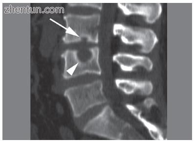 CT scan in the sagittal plane of two Schmorl's nodes.jpg