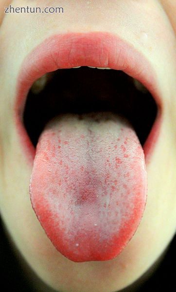 Normal appearance of the tongue, showing a degree of visible white coating and n.jpg