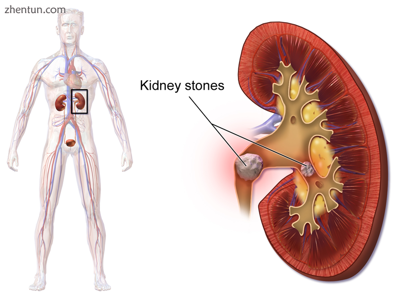 Illustration of kidney stones.png