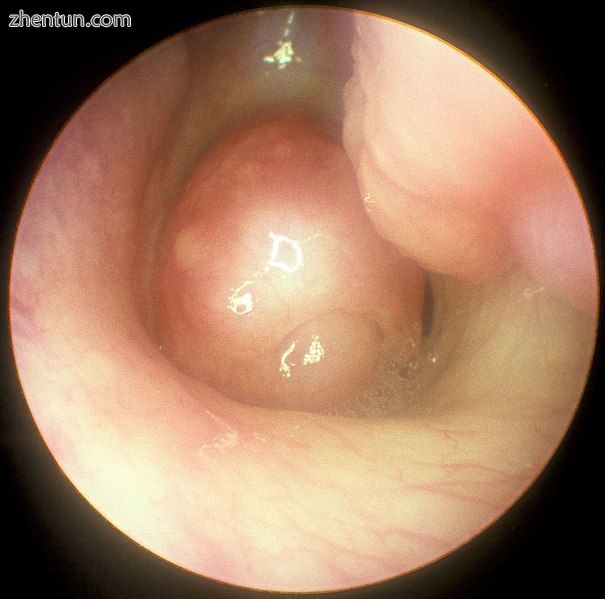 Large nasal polyp (round mass, center), which is commonly treated and removed by FESS..jpg