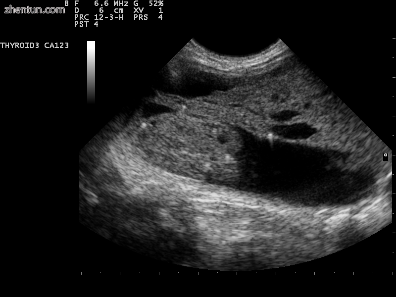 Comet tail artifacts from a colloid nodule is highly suggestive of a benign nodule..png