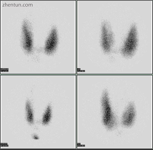 Thyroid scan.jpg