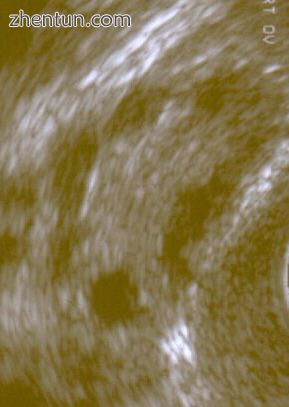 A polycystic ovary shown on an ultrasound.jpg