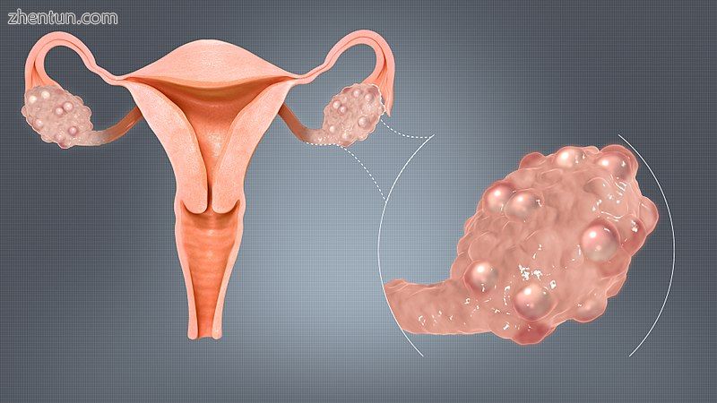 Polycystic ovaries.jpg