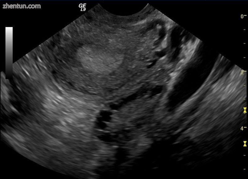 Transvaginal ultrasound scan of polycystic ovary.jpg