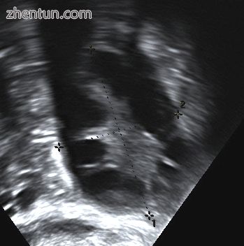 Polycystic ovary as seen on sonography.jpg