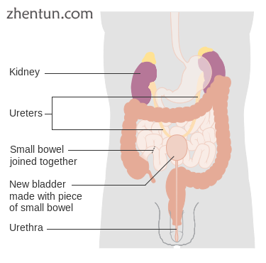 Surgical reconstruction of the bladder following removal..png