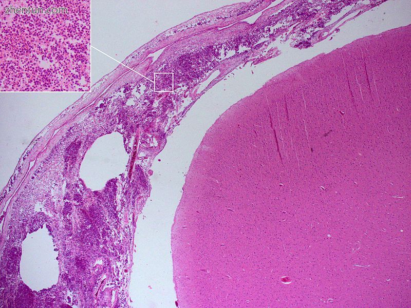 Histopathology of bacterial meningitis.jpg