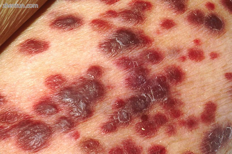 Kaposi's sarcoma on the skin of an AIDS patient.jpg