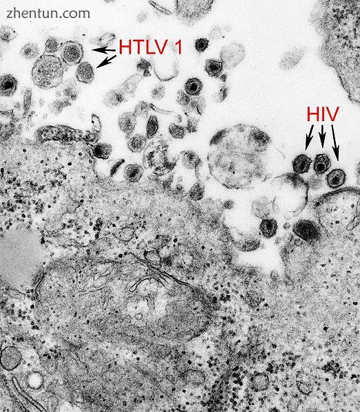 This image revealed the presence of both HTLV-1, and HIV..jpg