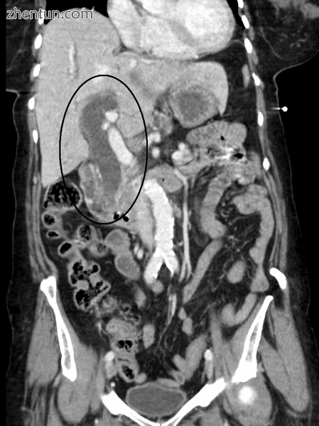 Biliary tract dilation due to obstruction as seen on CAT scan.png