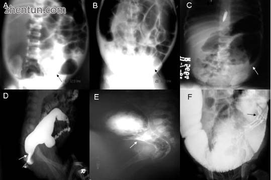 A Plain abdominal radiograph showing a PARTZ at rectosigmoid, arrow..jpg