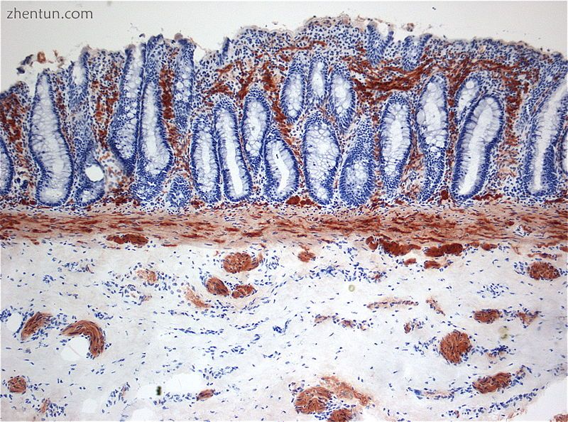 Histopathology of Hirschsprung disease showing abnormal acetylcholine esterase (.jpg