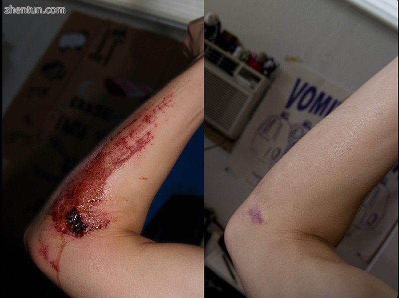 Hypertrophic scarring one year after road rash on the right, and the original wo.jpg