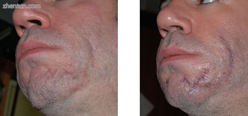 Scarring caused by acne (left), and photo one day after scar revision surger.jpg