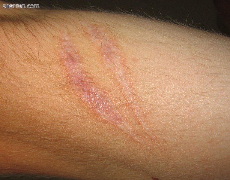 Scar tissue on an arm.jpg