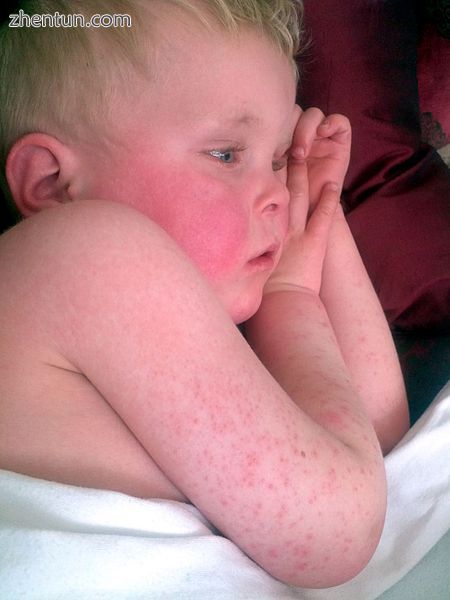 Characteristic red cheeks and rash of scarlet fever.jpg
