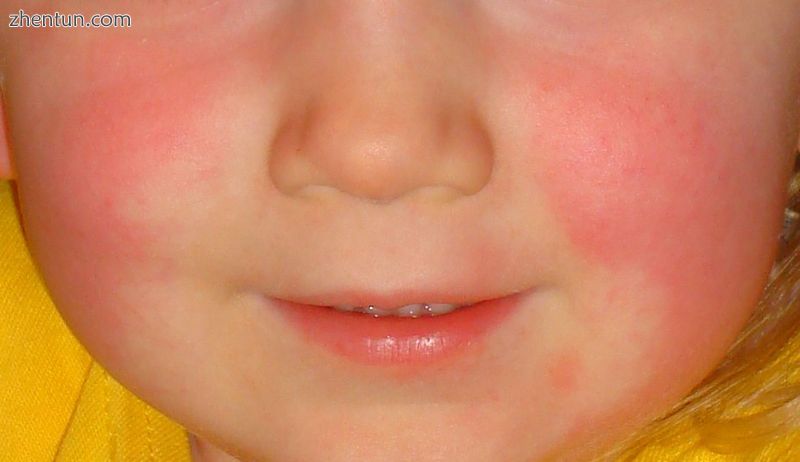 Red cheeks and pale area around the mouth in scarlet fever.JPG