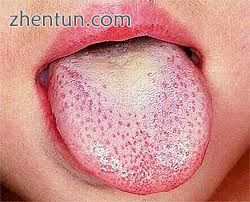 Strawberry tongue is a characteristic of scarlet fever.jpg