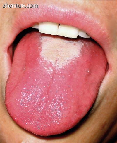 Strawberry tongue seen in scarlet fever.JPG