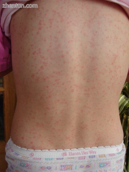 The rash of scarlet fever.jpg