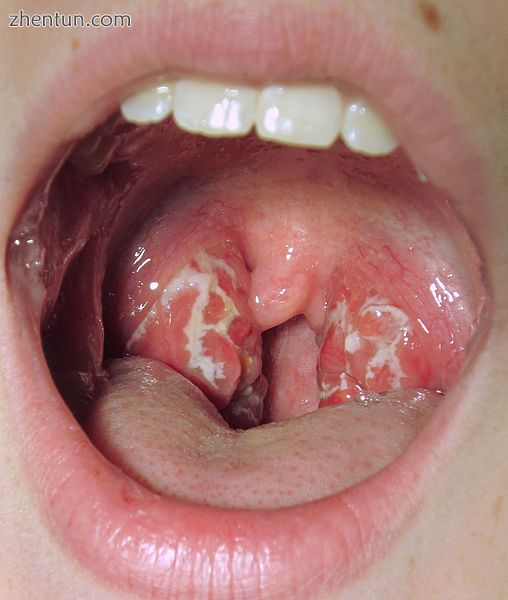 Throat of a child with a positive throat culture for streptococcal pharyngitis.JPG