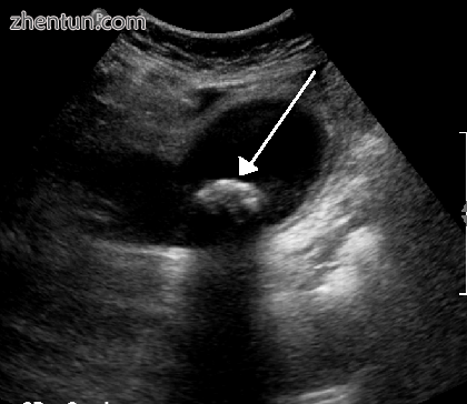 Biliary colic is often related to a stone in the gallbladder.PNG