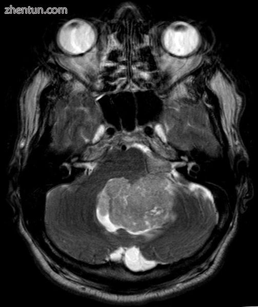 Ependymoma of 4.ventricle in MRI.1.jpg