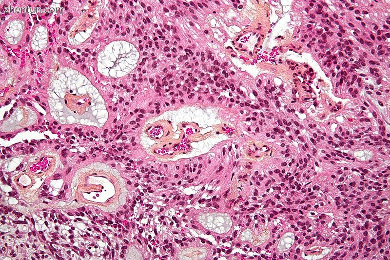 Micrograph of a myxopapillary ependymoma. HPS stain..jpg