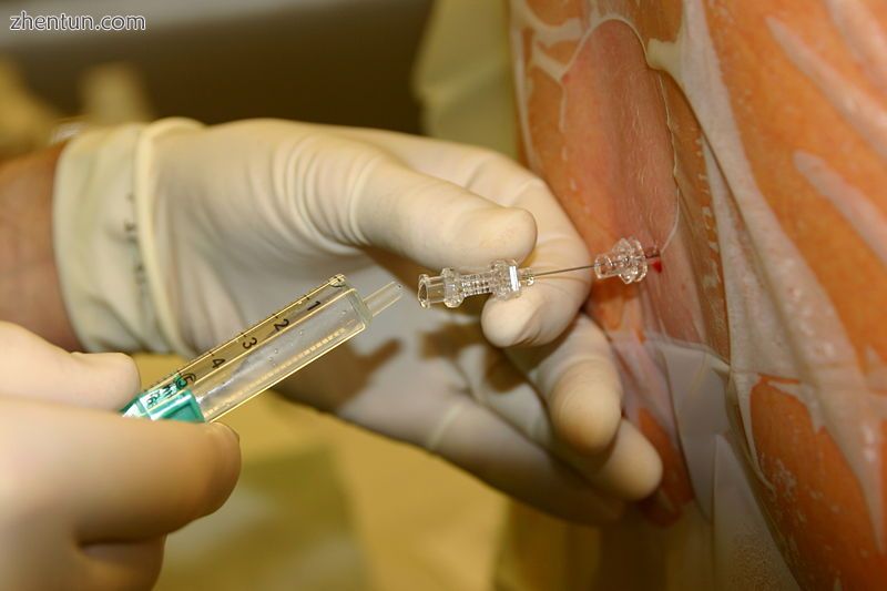 Backflow of cerebrospinal fluid through a spinal needle after puncture of the ar.jpg