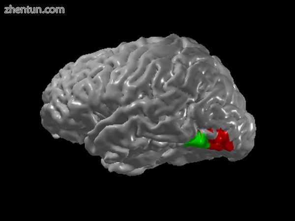 Regions thought to be cross-activated in grapheme-color synesthesia (green=graph.jpg