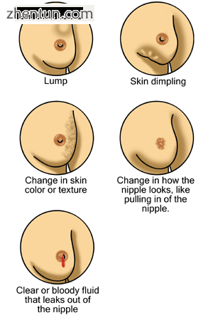 Early warning signs of breast cancer.png