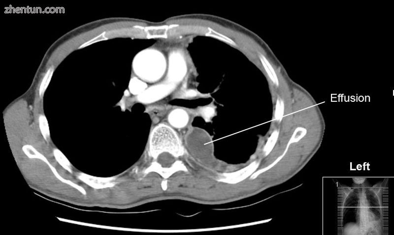 CT scan of the chest showing a left-sided pleural effusion. The fluid usually se.jpg