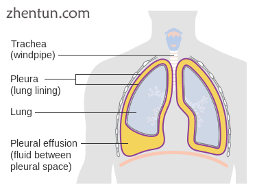 Diagram of fluid buildup in the pleura.png