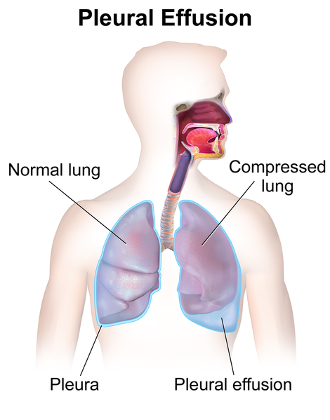 Pleural effusion.png