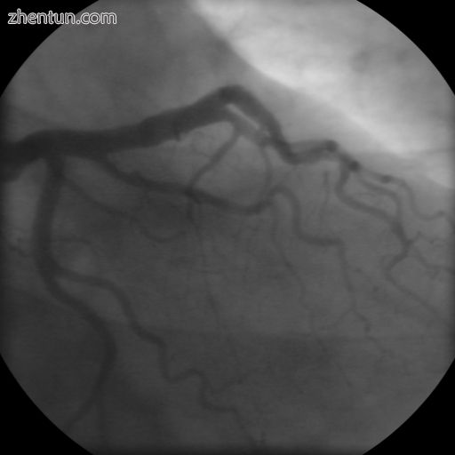 Coronary angiogram of a man.jpg