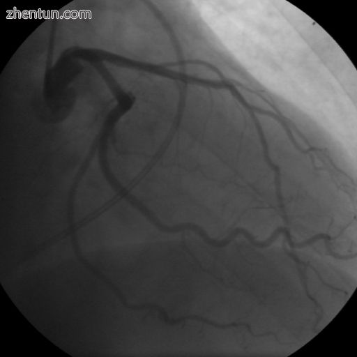 Coronary angiogram of a woman.jpg