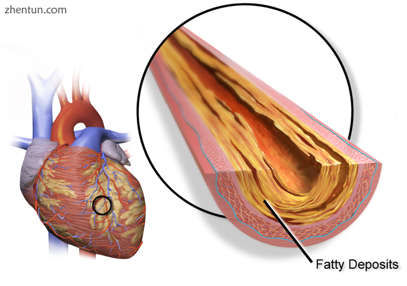 Illustration depicting atherosclerosis in a coronary artery..png