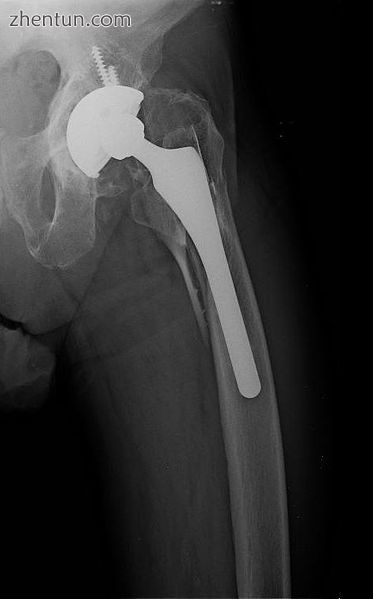 Periprosthetic fracture of left femur.jpg