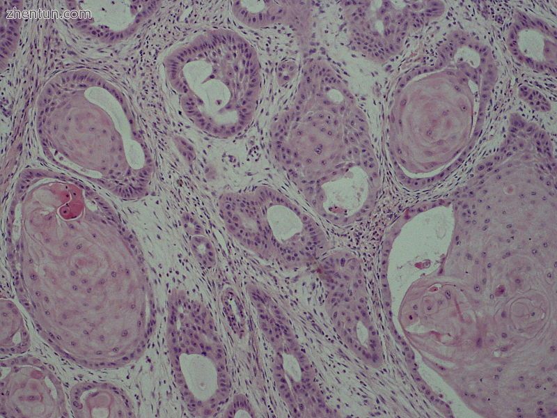Adenoid squamous cell carcinoma.JPG
