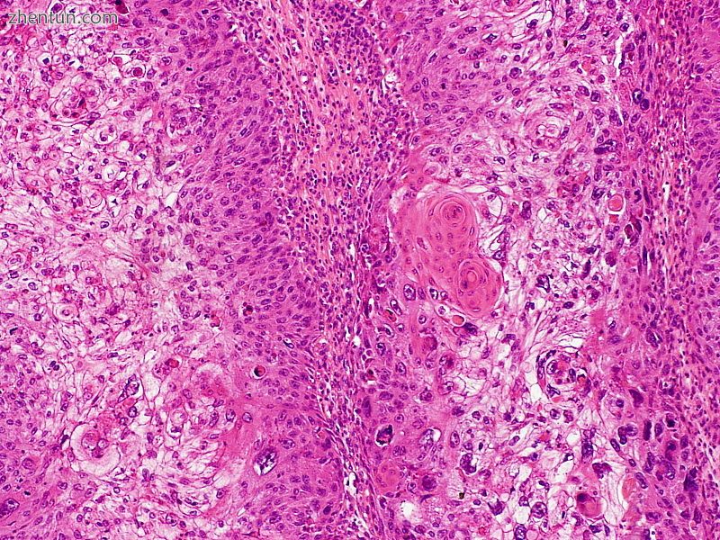 Clear-cell squamous cell carcinoma.JPG