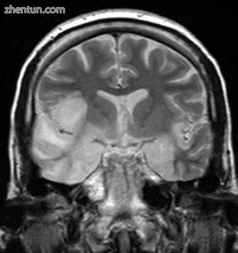 MRI scan image shows high signal in the temporal lobes and right inferior fronta.jpg