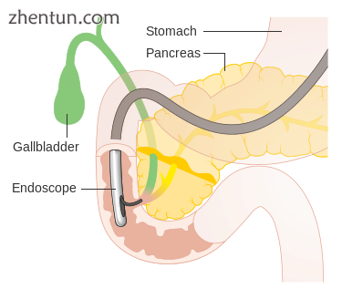 In ERCP, the endoscope enters through the mouth and passes through the stomach a.png
