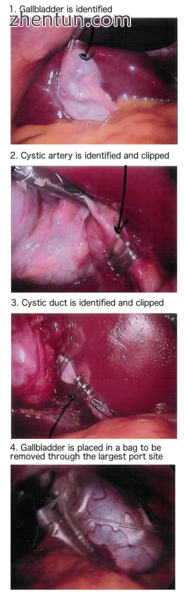 Steps of a cholecystectomy, as seen through a laparoscope..png